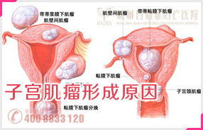 子宫肌瘤形成原因