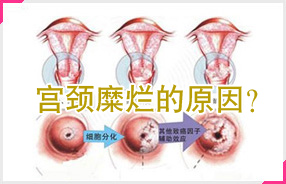 宫颈糜烂的原因