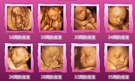 杭州哪家医院拍四维彩超写真好