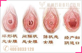 处女膜修复